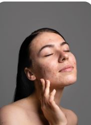 Melasma Treatment